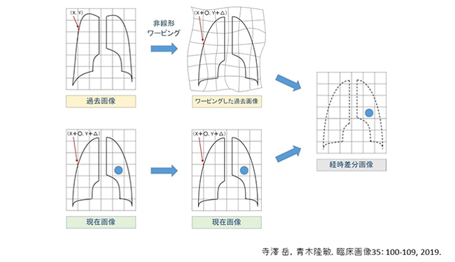 胸部単純X線写真の経時的差分画像作成