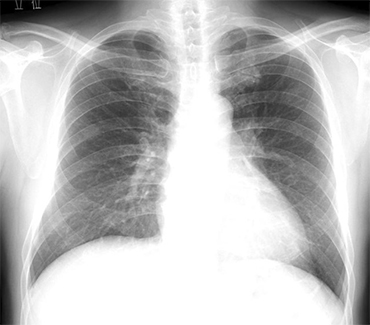 胸部単純X線写真